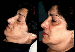 laser hair removal results