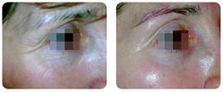 juvederm ultra treatment results