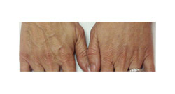 radiesse treatment results