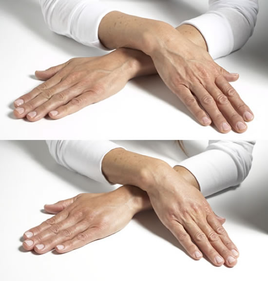 Radiesse hands rejuvenation