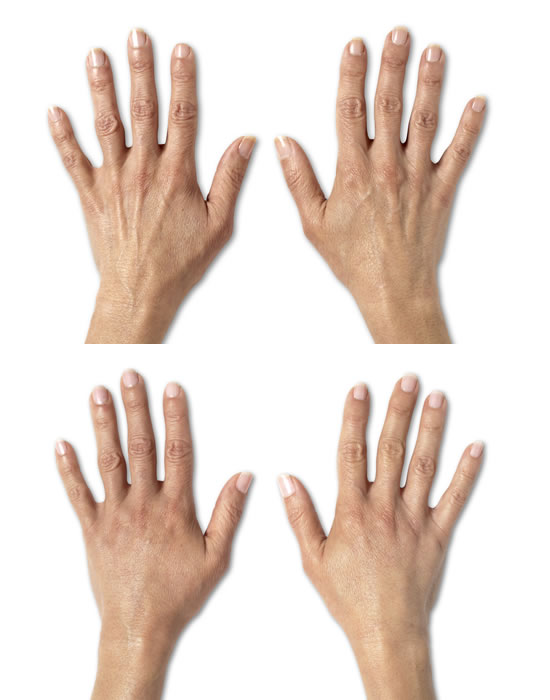 Radiesse hand rejuvenation