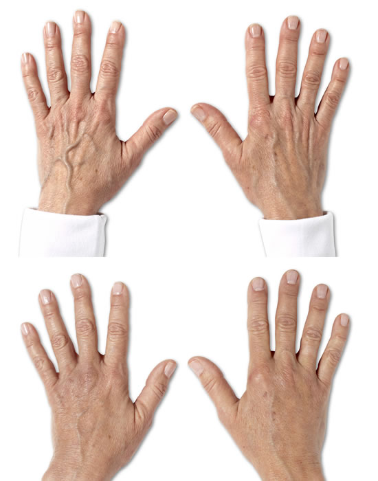Radiesse hands07